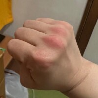 おてて痛い痛い??