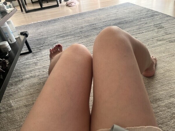 アザの発現で、より元気いっぱいのT様