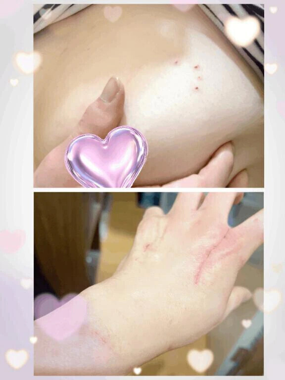 名誉の負傷😹