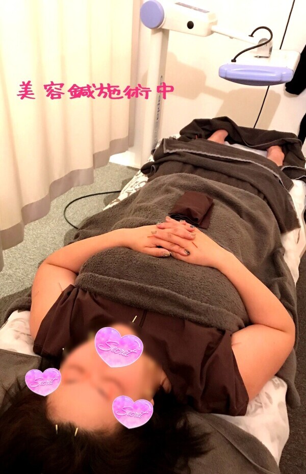 【北海道里帰り3日目美容鍼】