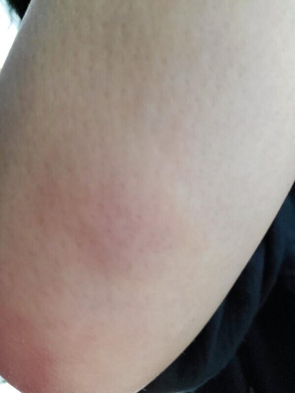 昨日の肘～(-_-;)