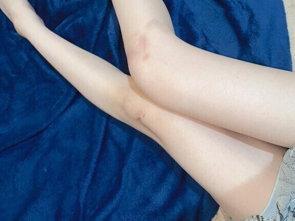 足の怪我🤫（無事です）