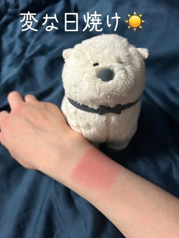変な日焼けをしてしまった☀️