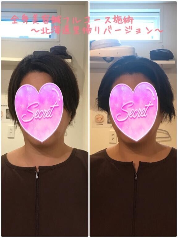 【全身美容鍼フルコース～北海道里帰り編～】