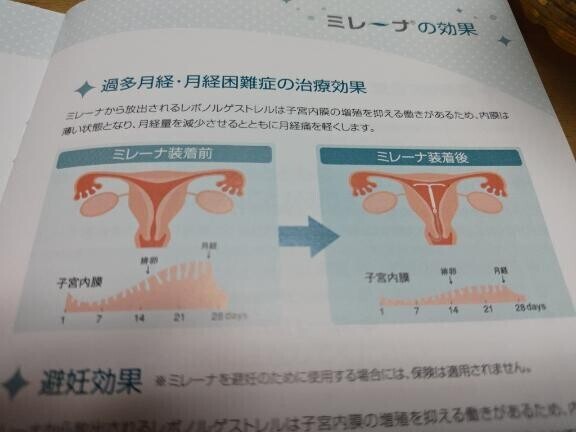 婦人科でミレーナを入れました！